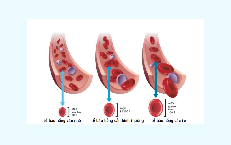 MCV trong xét nghiệm máu là gì? MCV cao hay thấp có ý nghĩa gì 3