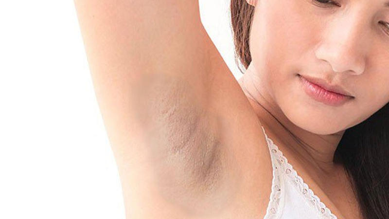 Mẹ bầu bị thâm nách​ có sao không? Cách xử trí an toàn, lành tính giúp chị em tự tin hơn 1