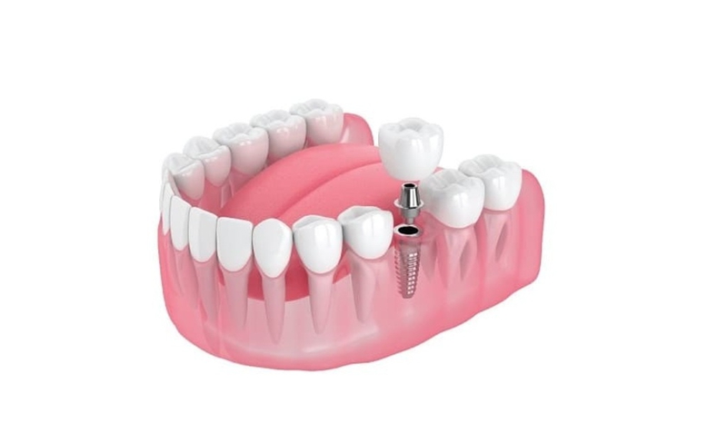 Megagen implant là gì? Có ưu điểm gì so với các loại implant khác? 4
