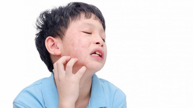 Mẹo chữa quai bị ở trẻ em an toàn và hiệu quả tại nhà 1
