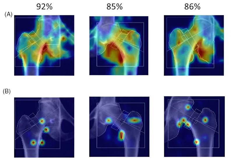 Mô hình AI dự đoán nguy cơ gãy xương bằng cách quét xương 3