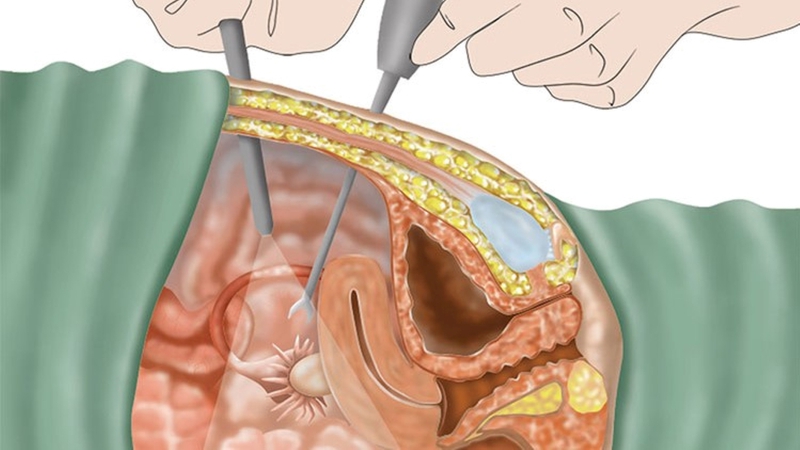 Mổ nội soi tắc 2 vòi trứng và những điều cần biết