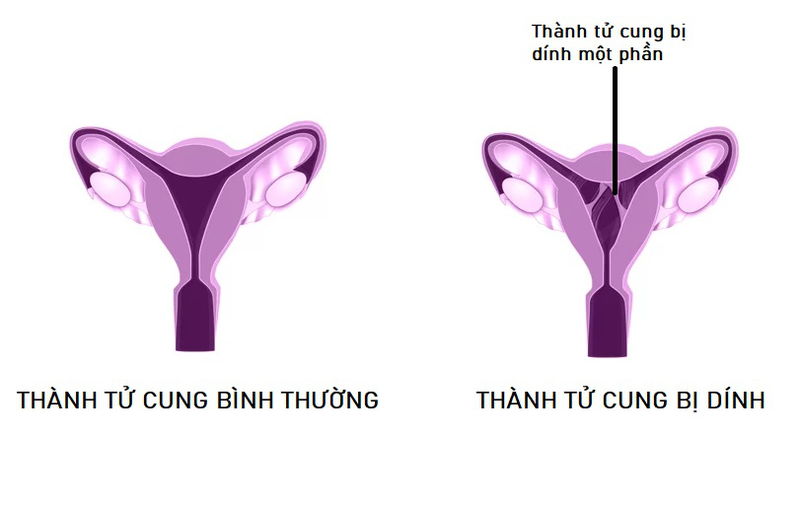 mo-tach-dinh-thanh-tu-cung-1.jpg