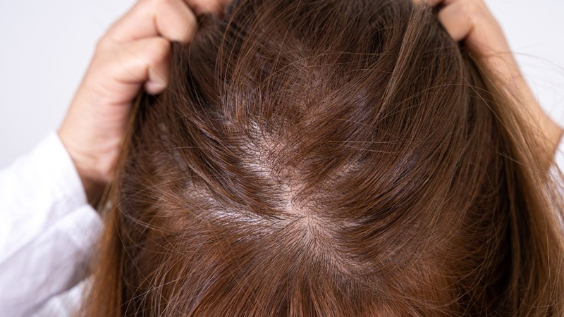 Tóc mỏng: Nguyên nhân và giải pháp điều trị hiệu quả 2