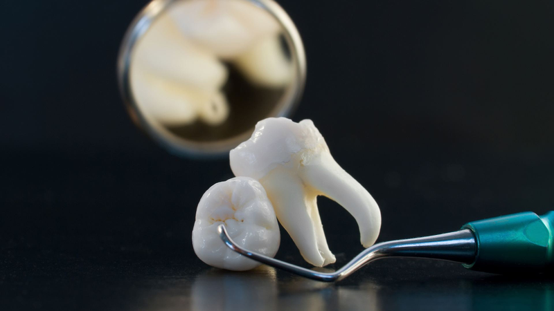 Khám răng định kỳ giúp phát hiện sớm răng khôn mọc lệch