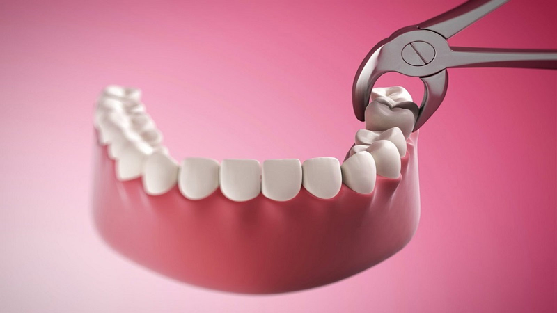 Mọc răng khôn khi đang niềng răng có sao không? 3