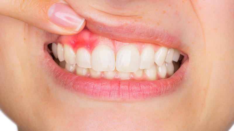 Mọc răng khôn khi đang niềng răng có sao không? 4