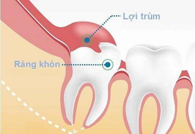 Mọc răng khôn nuốt nước bọt đau có nguy hiểm không và cách xử lý? 1