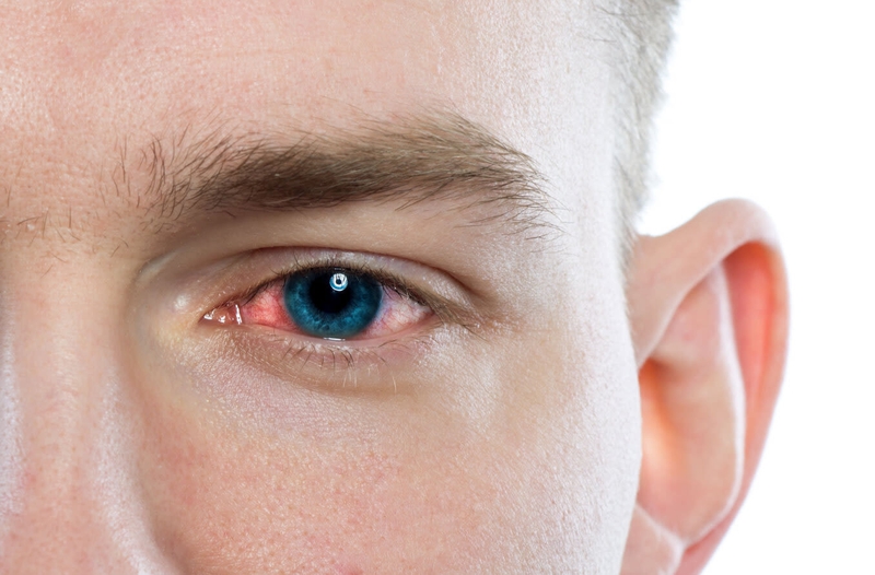 Một số biến chứng đau mắt đỏ1