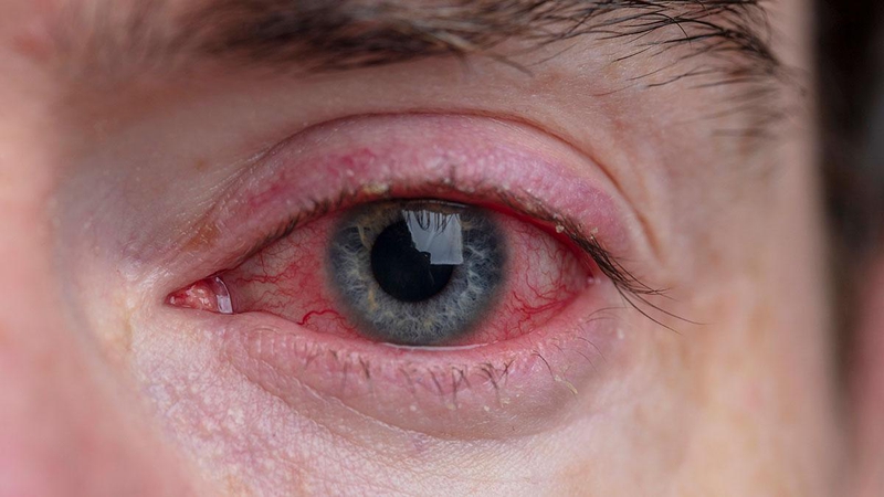 Một số biến chứng đau mắt đỏ2