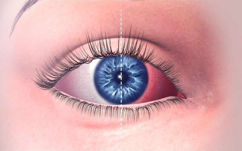 Một số biến chứng đau mắt đỏ3