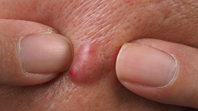 Đừng bỏ qua! Cách xử lý mụn bọc sưng to​ an toàn, hạn chế thâm sẹo 1