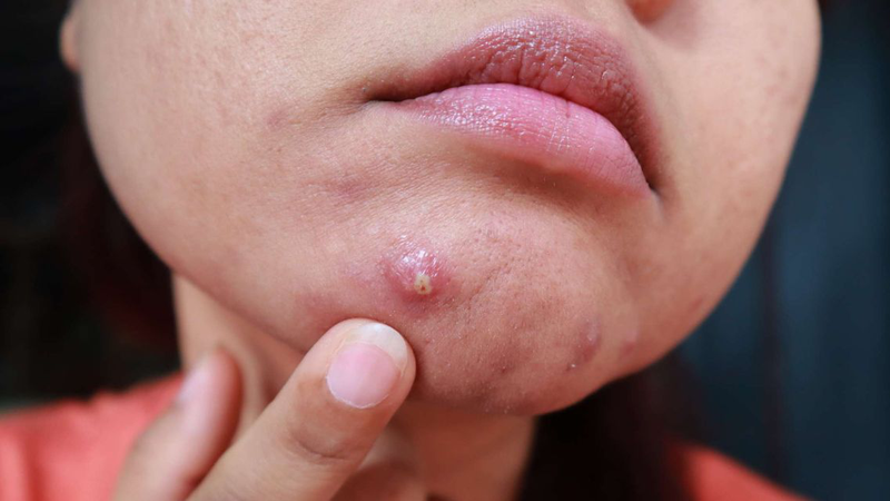 Đừng bỏ qua! Cách xử lý mụn bọc sưng to​ an toàn, hạn chế thâm sẹo 4
