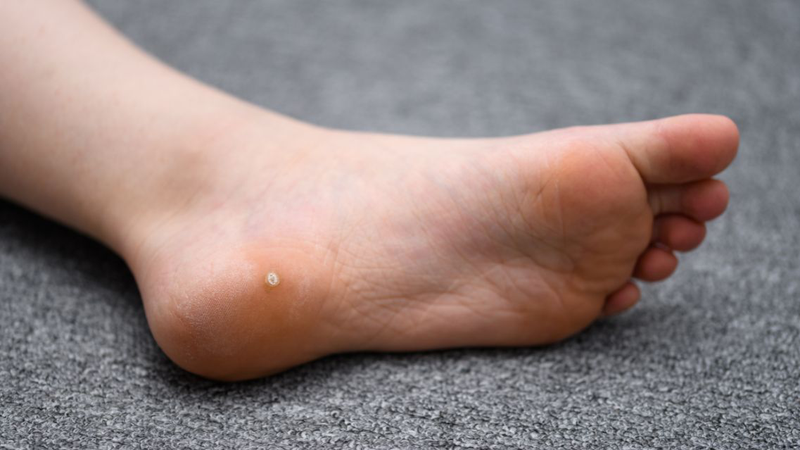 Mụn cóc ở chân: Làm sao để loại bỏ an toàn, không tái phát​ 2