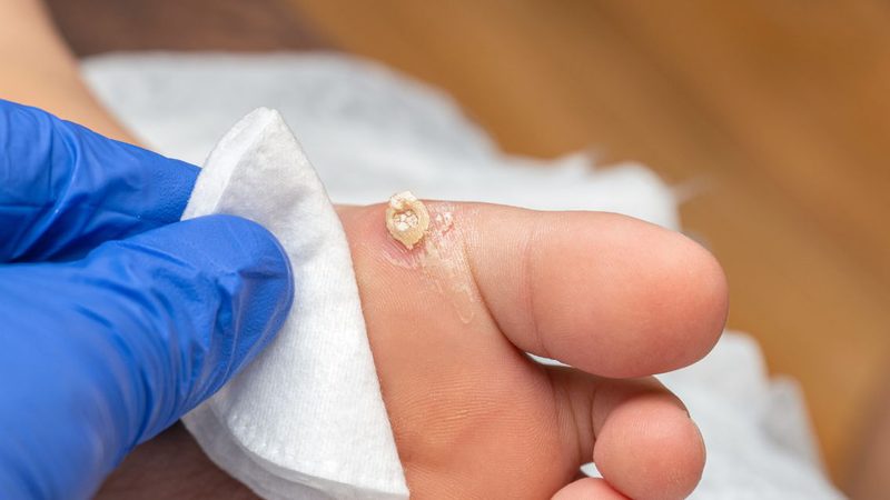 Mụn cóc ở chân: Làm sao để loại bỏ an toàn, không tái phát​ 4