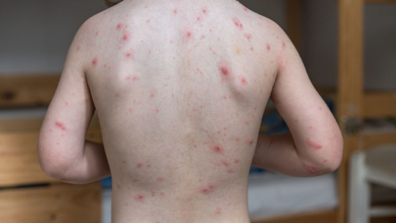 Mụn do HIV thường không có khác biệt rõ rệt so với các loại mụn thông thường