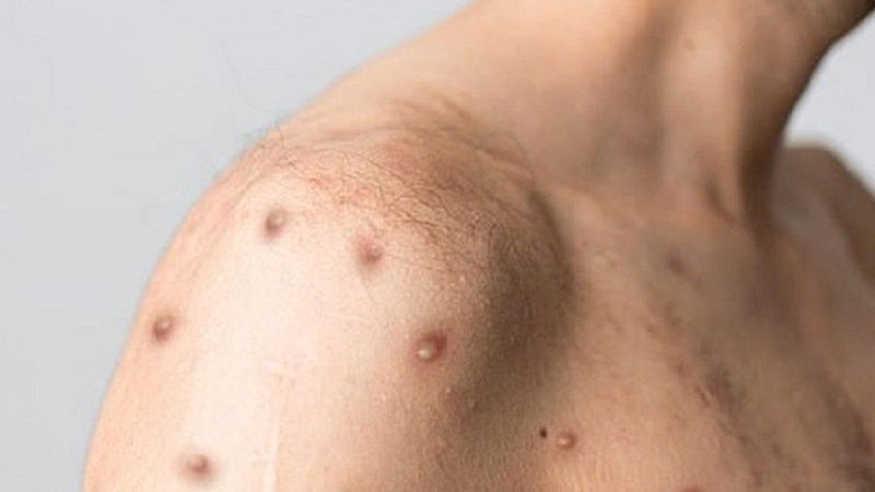 Mụn HIV không gây ngứa như các loại mụn khác