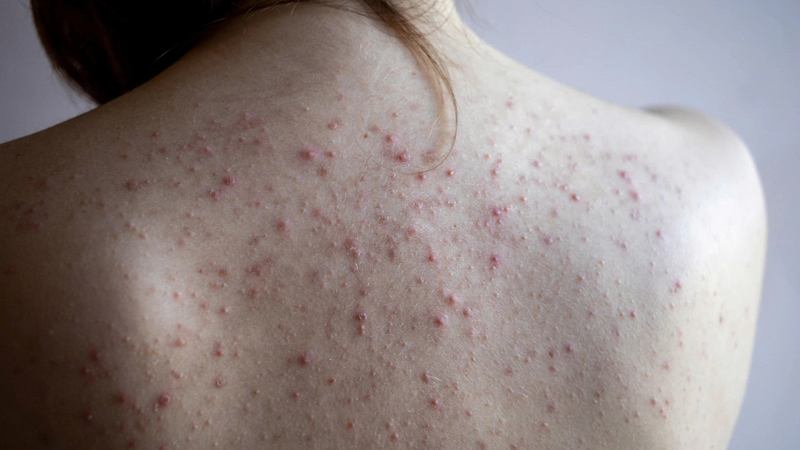 Bị mụn ở lưng không đồng nghĩa với việc đó là mụn do HIV
