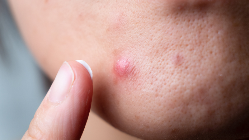 Mụn nang có tự hết không? Những điều bạn cần biết để xử lý đúng cách 1
