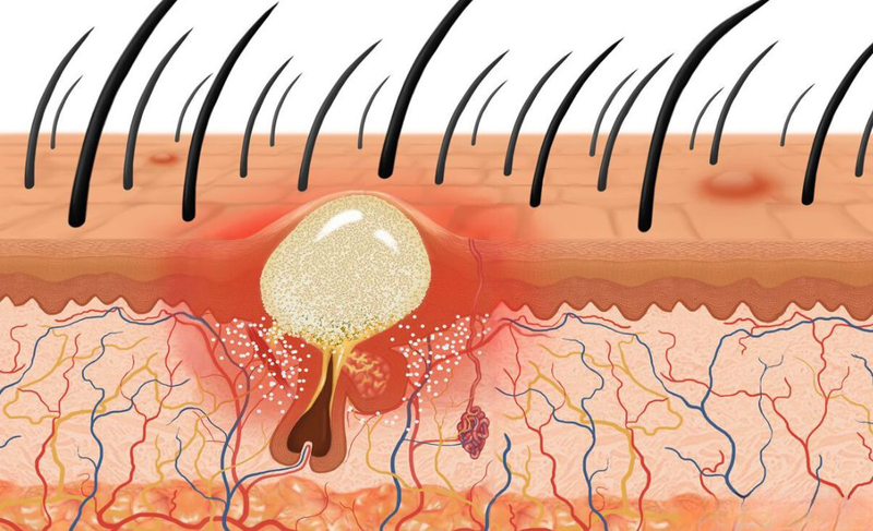 Mụn nhọt ở đầu​: Nguyên nhân, triệu chứng, cách điều trị 1