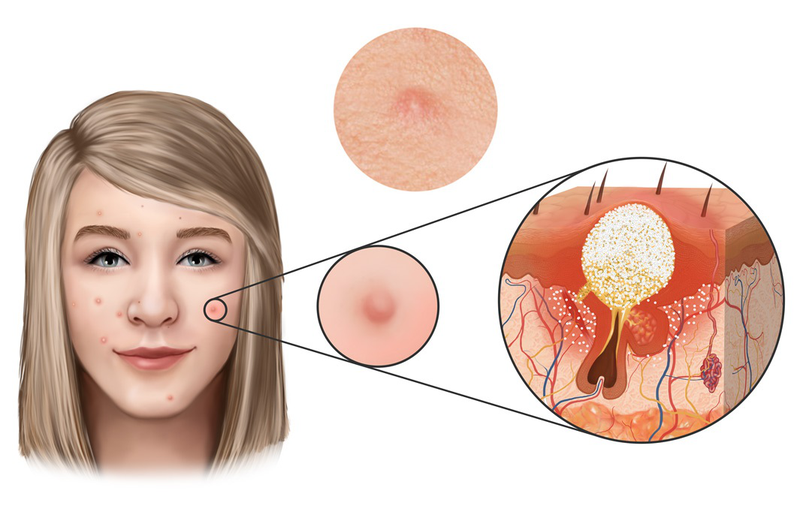 Mụn sẩn là gì? Nguyên nhân gây mụn và cách chữa mụn sẩn hiệu quả 1