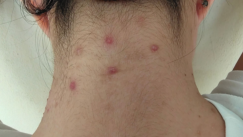 mun-sau-gay-nguyen-nhan-va-cach-khac-phuc-an-toan-hieu-qua-2.jpg