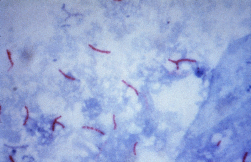 Mycobacterium Tuberculosis và những điều bạn cần biết 3