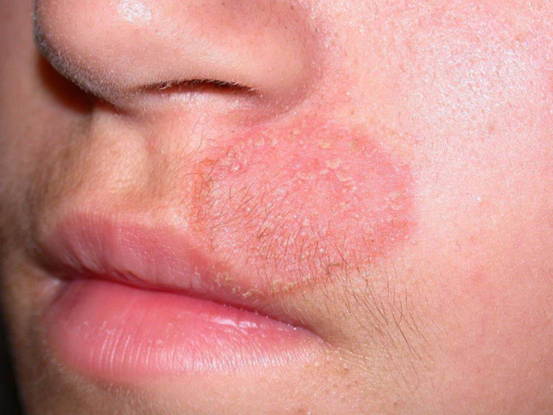 Nấm da mặt: Nguyên nhân, triệu chứng và cách chữa trị 4