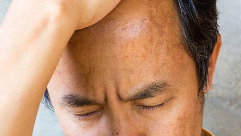 Nám da mặt ở nam giới: Nguyên nhân và phương pháp điều trị 1