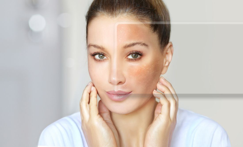 Nám thường xuất hiện ở độ tuổi nào? Cách phòng ngừa nám da 3