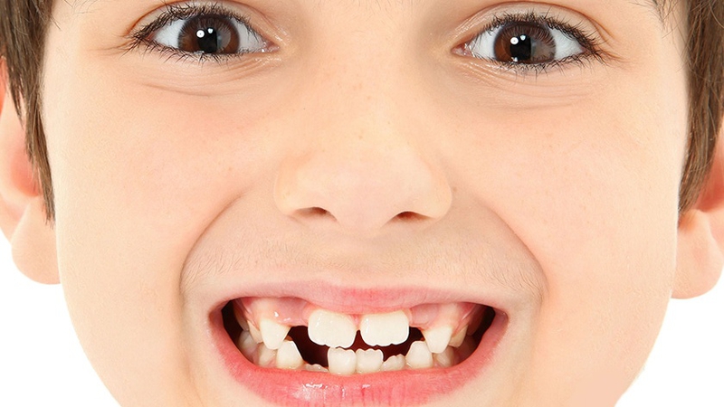 Phương pháp nắn chỉnh răng cho trẻ em có thể bạn chưa biết 1