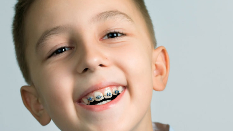 Phương pháp nắn chỉnh răng cho trẻ em có thể bạn chưa biết 3