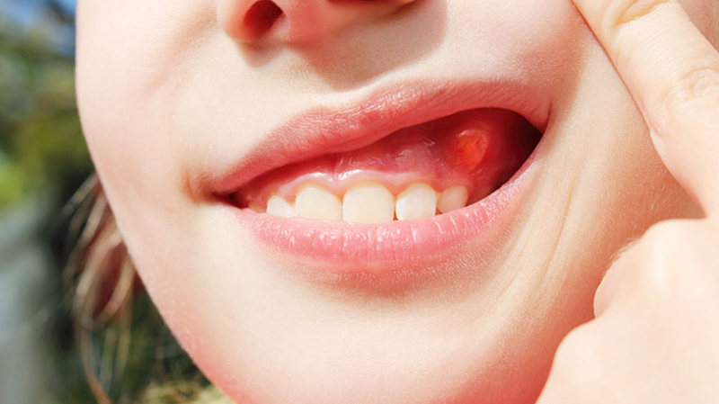 Nang chân răng là gì? Triệu chứng và cách điều trị 3