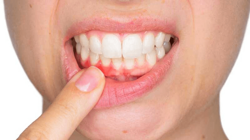 Nang chân răng là gì? Triệu chứng và cách điều trị 1