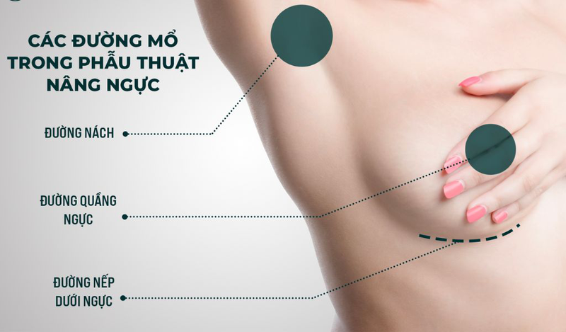 Nâng ngực đường quầng là gì? Những ai có thể thực hiện? 1