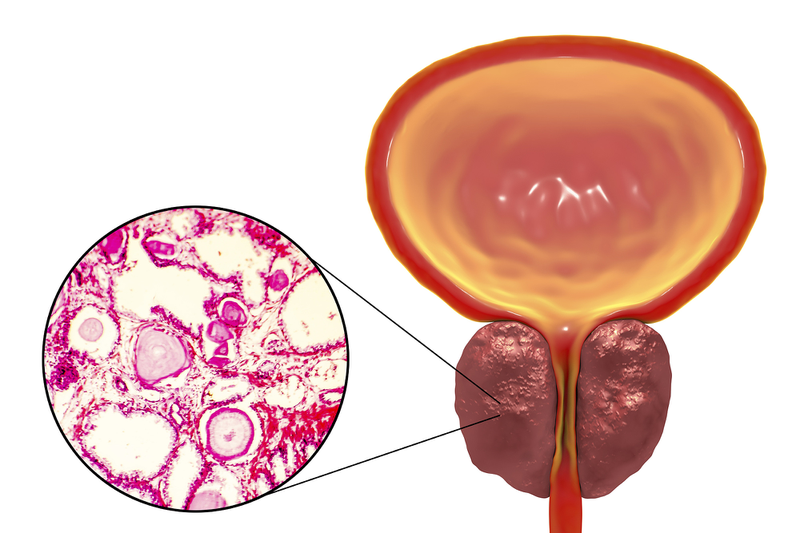 Nang tuyến tiền liệt là tình trạng các tế bào trong tuyến tiền liệt phát triển quá mức