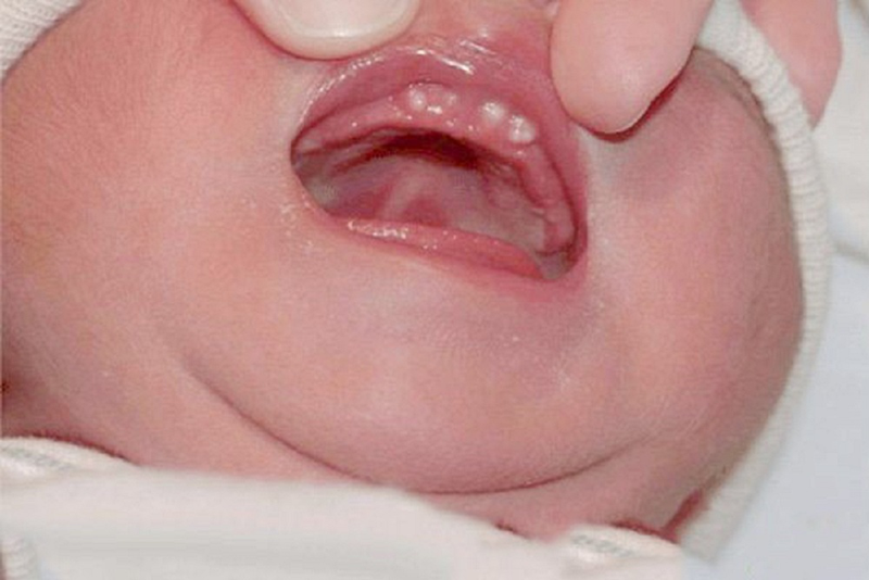 Nanh sữa ở trẻ sơ sinh có nguy hiểm không? Dấu hiệu và cách xử trí 1