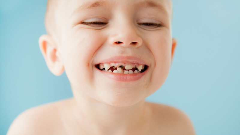 Nên làm gì khi em bé bị sâu răng sữa? Phòng ngừa sâu răng ở trẻ 1