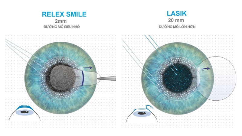 So sánh mổ cận Femto Lasik và Relex Smile: Nên chọn phương pháp nào? 2