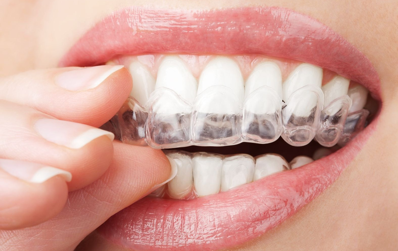 Nên niềng răng trong suốt hay mắc cài? So sánh chi tiết 3