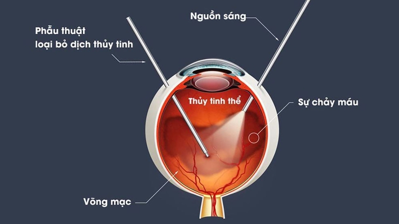 Nên thay thủy tinh thể khi nào? Chi phí ra sao? 4