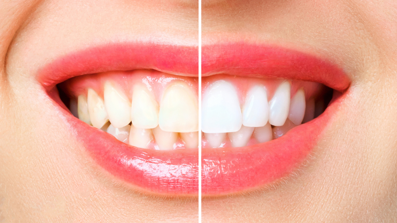 Luôn phải thực hiện đúng các bước sử dụng máng ngậm trắng răng 3