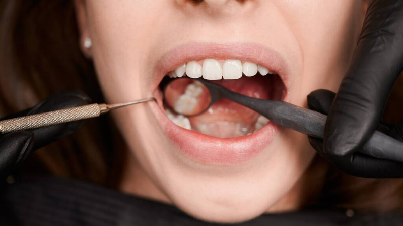 Khi bị nghiến răng khi ngủ, bạn nên kiểm tra răng miệng 6 tháng một lần