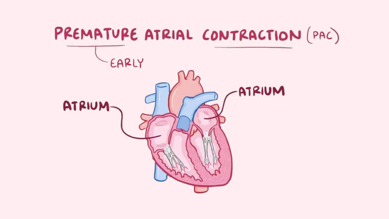 Ngoại tâm thu nhĩ là một dạng rối loạn nhịp tim đặc trưng bởi sự co bóp sớm bất thường của tâm nhĩ