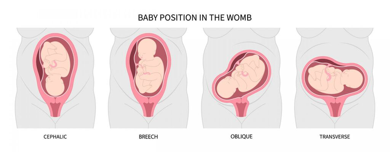 Ngôi thai là gì? Tầm quan trọng của việc xác định ngôi thai trong chuyển dạ 2