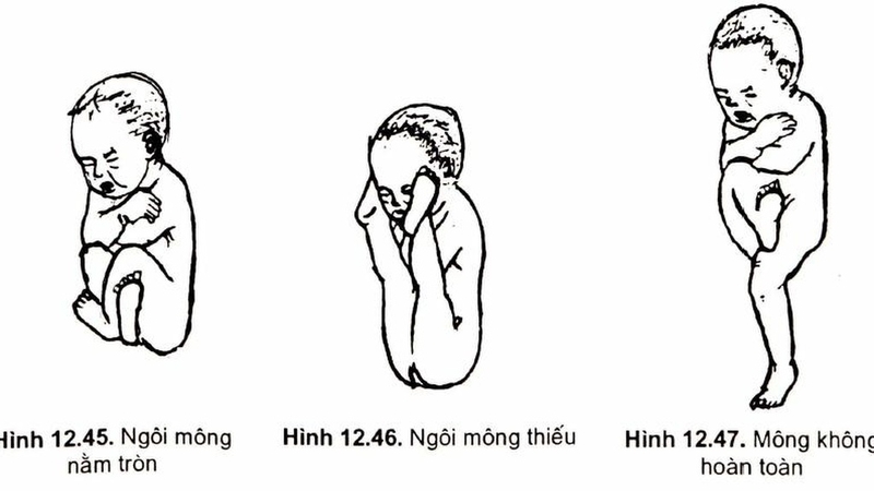 Ngôi thai ngược: Hiểu rõ về tình trạng và cách xử lý an toàn 1