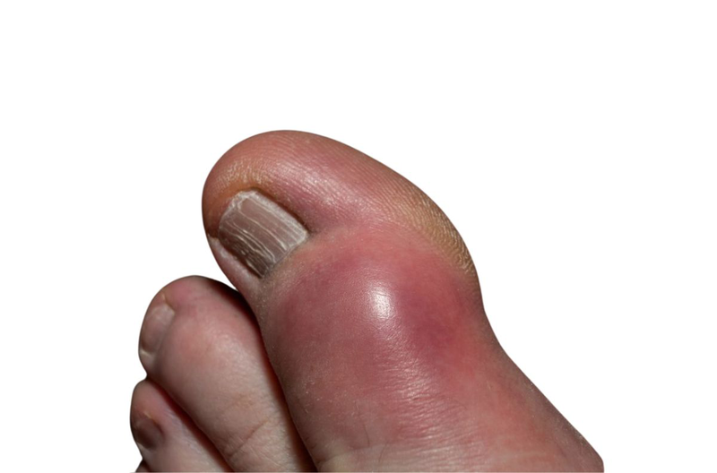 Ngón chân bị sưng là triệu chứng bệnh gì? Làm gì khi ngón chân bị sưng 3