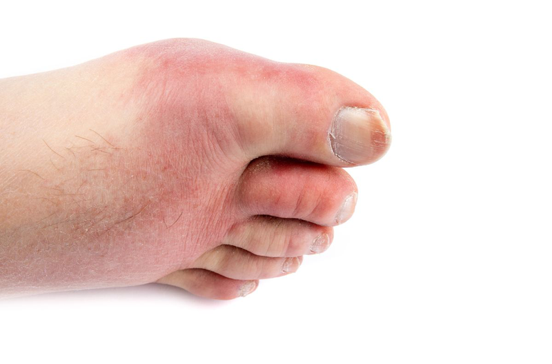 Ngón chân bị sưng là triệu chứng bệnh gì? Làm gì khi ngón chân bị sưng 1