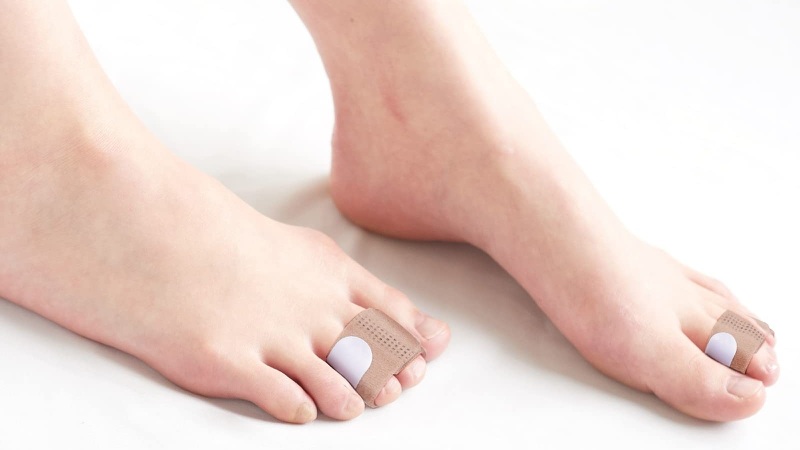 Ngón chân hình búa là gì? Nguyên nhân và cách điều trị ngón chân hình búa 6