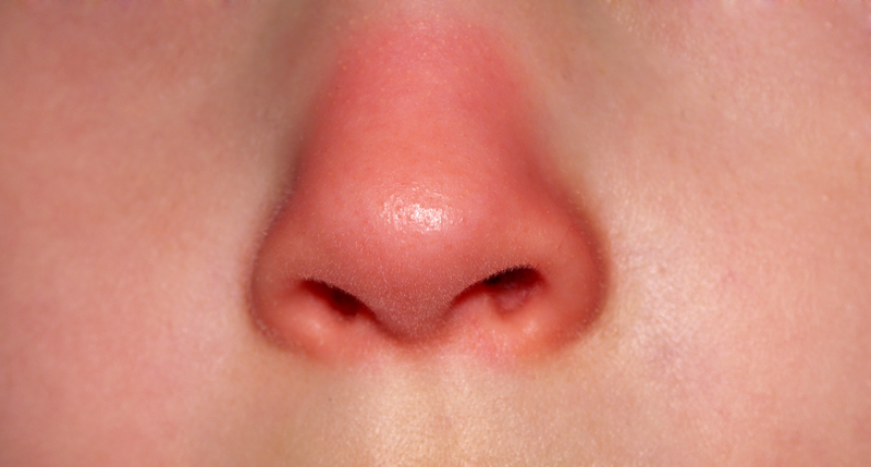 Ngứa đỏ hai bên cánh mũi có phải bệnh không? 1